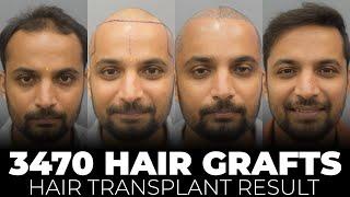 Get Rid of Hair Loss | Before and After Transformation | Cara Clinic