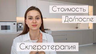 Сосудистые звездочки после беременности | Склеротерапия