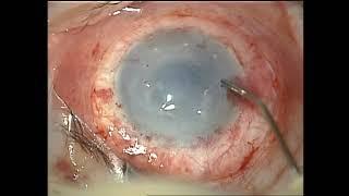 simple limbal epithelial transplantation (SLET)