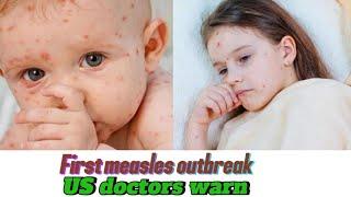 First measles case in South dakota