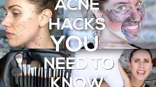 ACNE HACKS YOU NEED TO KNOW!