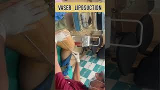 Thigh Liposuction Surgery Before and After in Jaipur | Rejuvena Cosmo Care by Dr. Deepesh Goyal