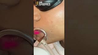 CO2 Laser Result II CO2 Laser Treatment for Acne Scars | Before After Results