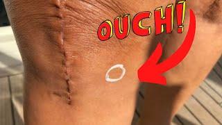 Pain on the Inside Edge of Knee After Total Knee Replacement