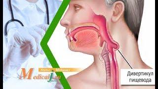 Дивертикулы пищевода. Причины, симптомы, лечение дивертикулеза