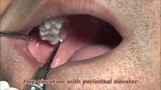 How to use cryers for extraction of buccoverted wisdom tooth