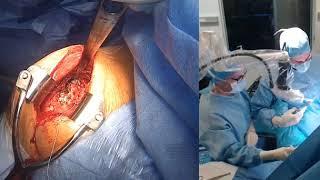 Revision of an anatomical total shoulder arthrosplasty by a reverse (with Dr. Fernandez)