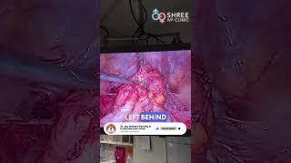 The Hidden Danger After Hysterectomy: Bowel Endometriosis Exposed | Dr Jay Mehta, Mumbai