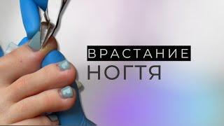 Врастание ногтя. Резекция осколка