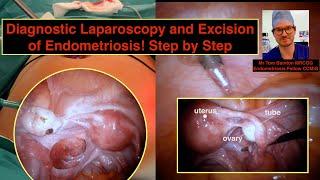 Diagnostic laparoscopy Step by Step - Excision of Endometriosis