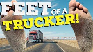 Feet of a Trucker:  Treating a Truck Driver with Severe Dry Hard Callused Feet