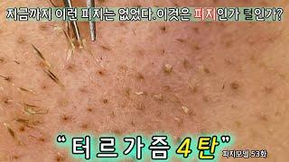 피지 직접 뽑아드렸습니다   피지제거 블랙헤드제거 피지뽑기   대한민국을 터르가즘으로 통일 해보겠다 노원 피지1짱 그녀 4탄