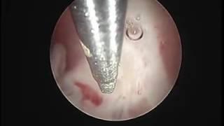 Hystroscopic resection of uterine septum by waleed almery