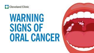 How to Screen Yourself for Oral Cancer