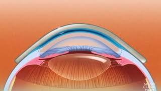 Keratoconus