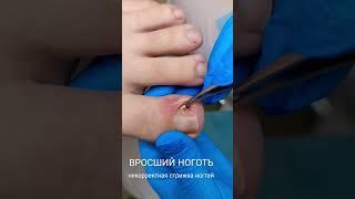 Вросший ноготь,неправильная стрижка ногтей, педикюр #аппаратныйпедикюр #подология #вросшийноготь