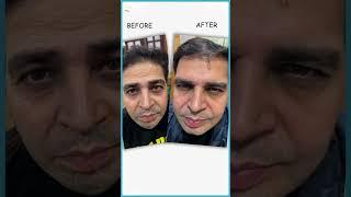 Forehead Botox Before and After | Best Clinics in Delhi for Wrinkle-Free Foreheads | AWISH Clinic