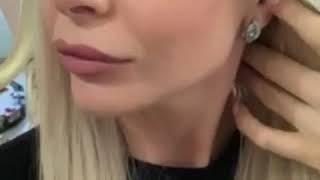 Коррекция подбородка и углов нижней челюсти препаратом  Juvederm® VoluxТМ