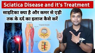 Sciatica treatment | Sciatica symptoms | Sciatica disease | Sciatica dard ka ilaj | Pharmahuts