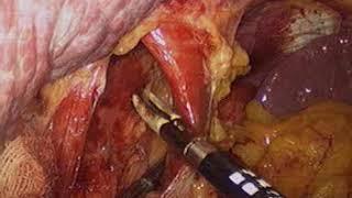 laparodcopic fundoplication  by Wael Tobar MD non edited