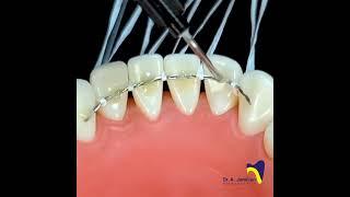 Fixed Retainer Procedure #dentist #orthodontist#Fixed_retainer#braces #retainer#retention#lingual