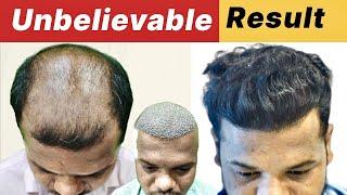 Exceptional Result in 10 Month After Hair Transplant | Best Hair Transplant Result in india 2024