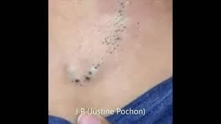 Énormes points noirs, zone sous cutanée infectée / huge blackheads, infected skin (Justine Pochon)