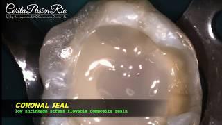 endo resto treatment on mandibular molar with four canals (spesialis konservasi gigi)