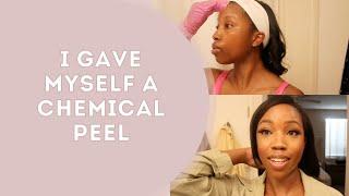 I gave myself a chemical peel | Realistic Esthetician 7 day chemical peel shedding