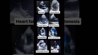 Echocardiogram NORMAL vs ABNORMAL! #radiology #cardiology