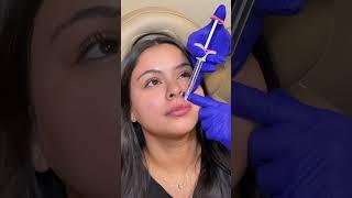 A glimpse into our lip filler process  #medicalaesthetics #lipfillers #lipfillerinjections