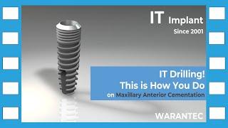 [warantec] IT Drilling! This is How You Do on Maxillary Anterior Cementation