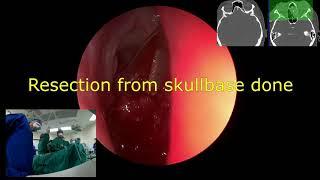 Endoscopic Excision Recurrent Inverted Papilloma