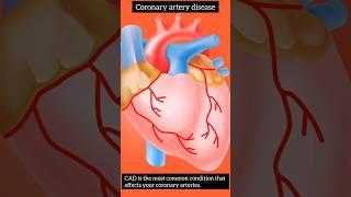 coronary artery disease:CAD #shorts #short #ptmedicoz