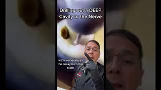 Removing Deep Cavity to Prepare for Root Canal | View Mobile Dental