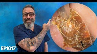 LONG EAR WAX PLUGS, DEEP EAR WAX REMOVAL AND SKIN REMOVAL - EP1017