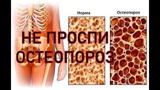 Два теста для для выявления остеопороза, которые вы можете сделать дома