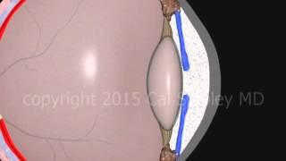 Cataract Surgery (phacoemulsification) by Cal Shipley, M.D.