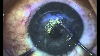 ReLEx SMILE: Minimally invasive laser eye surgery