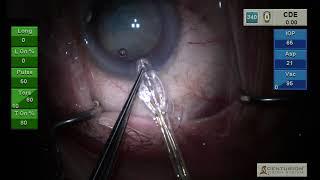 Dr. Cristos Ifantides: Dense Lens ZEPTO® Capsulotomy