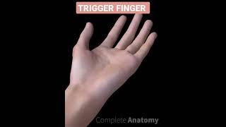 #handsurgery # triggerfinger #orthopaedics #hand #trigger #surgery #besthandsurgeon