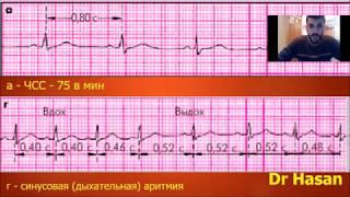 синусовая аритмия