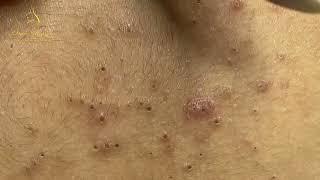 Loan Nguyen Acne Treatment 15566