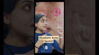 Bye! ACNE ke ZIDDI SPOTS!! Glowing Skin⭐ 5 Easy Tips️ #skincare #drdeepshikhashah #familydoctor