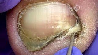 Very dirty nails bacteria infected onychomycosis【Doctor Liu Pedicure】