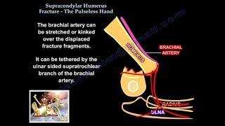 Supracondylar humerus fracture ,  pulseless hand  - Everything You Need To Know - Dr. Nabil Ebraheim