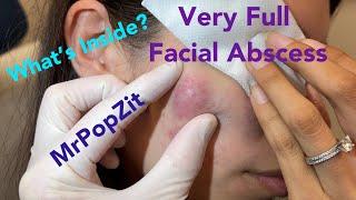 Very large facial abscess. So full and under pressure see the drainage and instant relief.