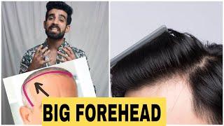 Big Forehead tips| Receding hairline #shorts #hairloss