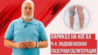 Эндовенозная лазерная облитерация. Варикоз на ногах 2ч.