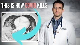 How COVID Kills Some People But Not Others - Doctor Explaining COVID